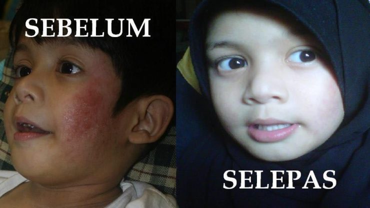 penawar_eczema