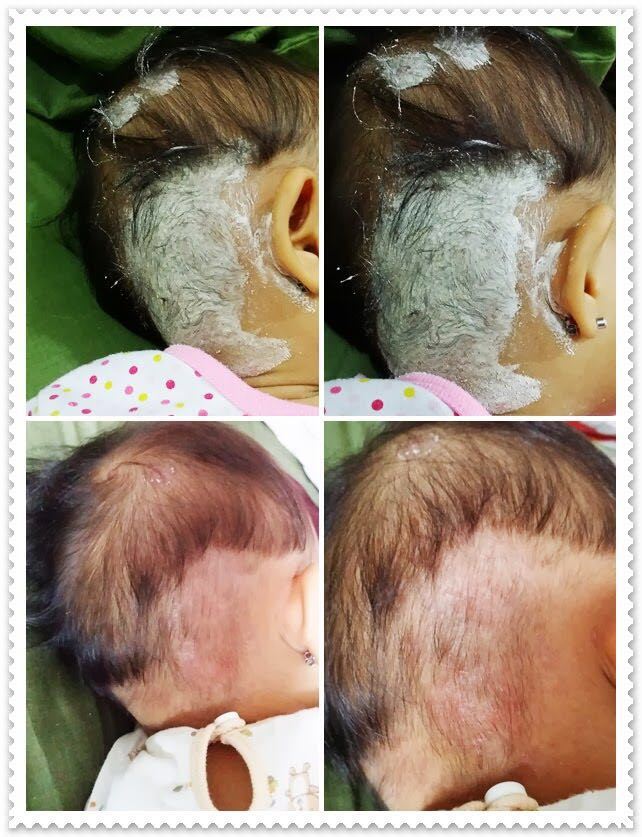 Cure Eczema